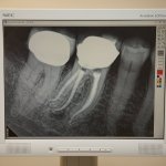 xray on screen